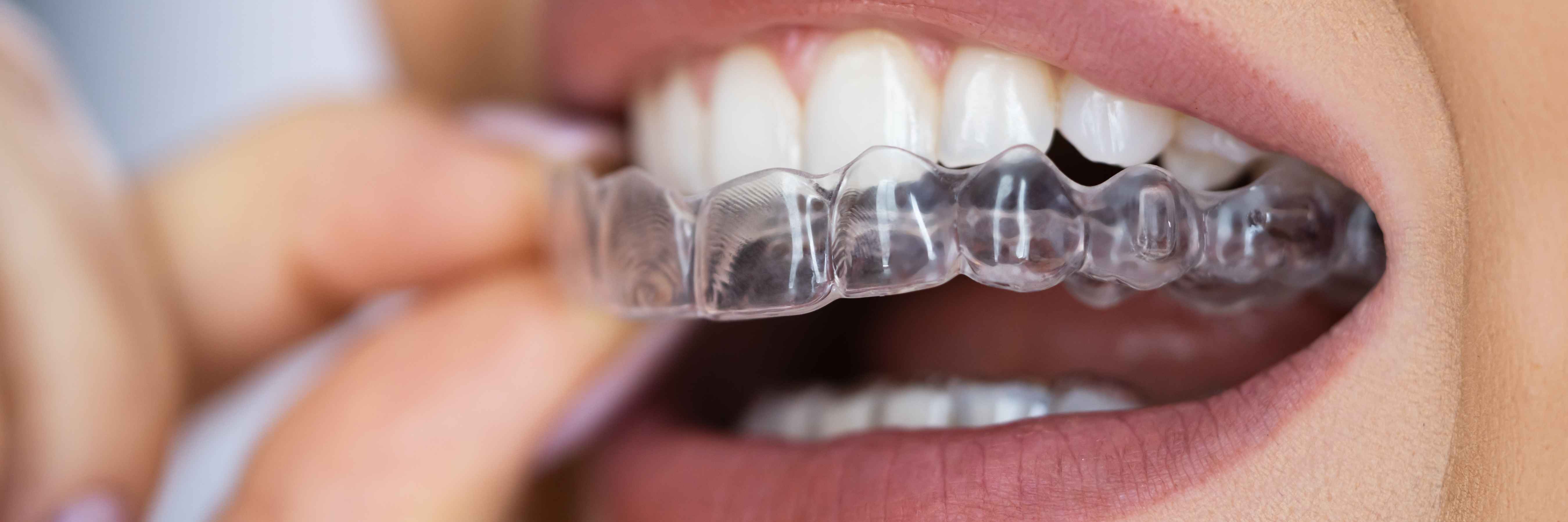 Aligners